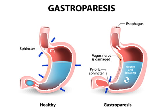Gastroparesis- Causes, Diagnosis, Treatment and Prevention
