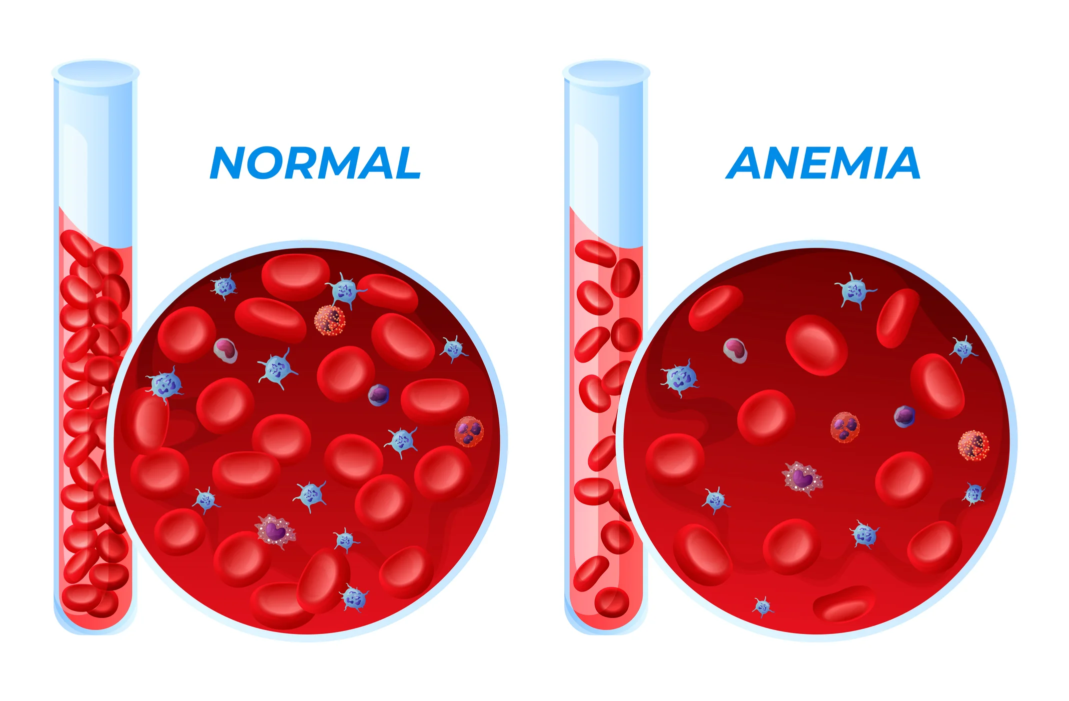 Anaemia: Nguyên Nhân, Triệu Chứng và Giải Pháp Điều Trị Hiệu Quả