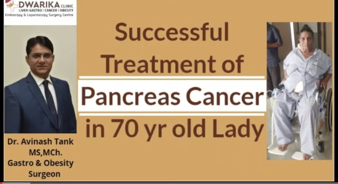 Successful Treatment of Pancreas Cancer in 70-Year-Old Woman at Ahmedabad