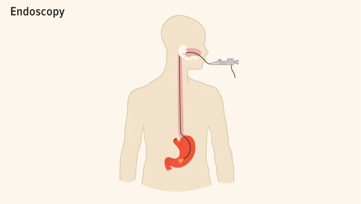 Drawing of human body showing endoscopy procedure