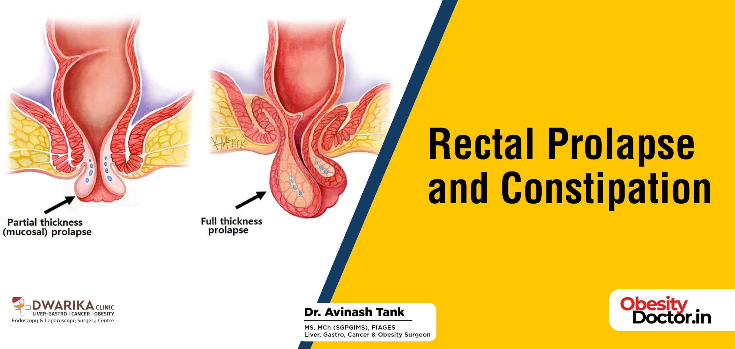 Rectal Prolapse and Constipation - Dr AvinashTank, is a super-specialist  (MCh) Laparoscopic Gastro-intestinal Surgeon,