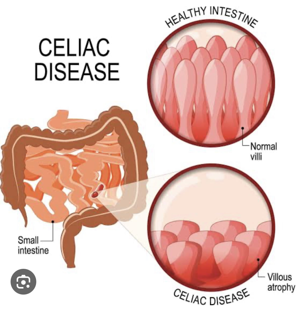 Celiac Disease: Causes, Diagnosis, and Treatment
