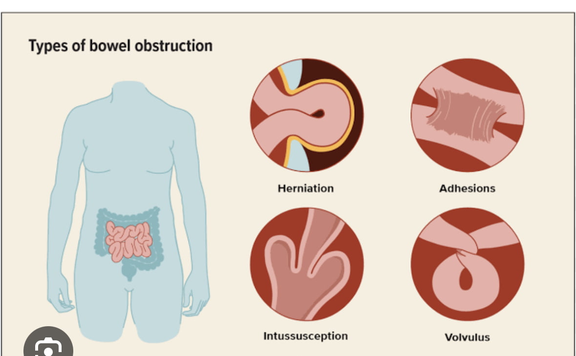 Small Bowel Obstruction: Causes, Symptoms & Treatment.