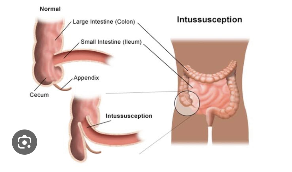 Intussusception and Small Bowel Obstruction