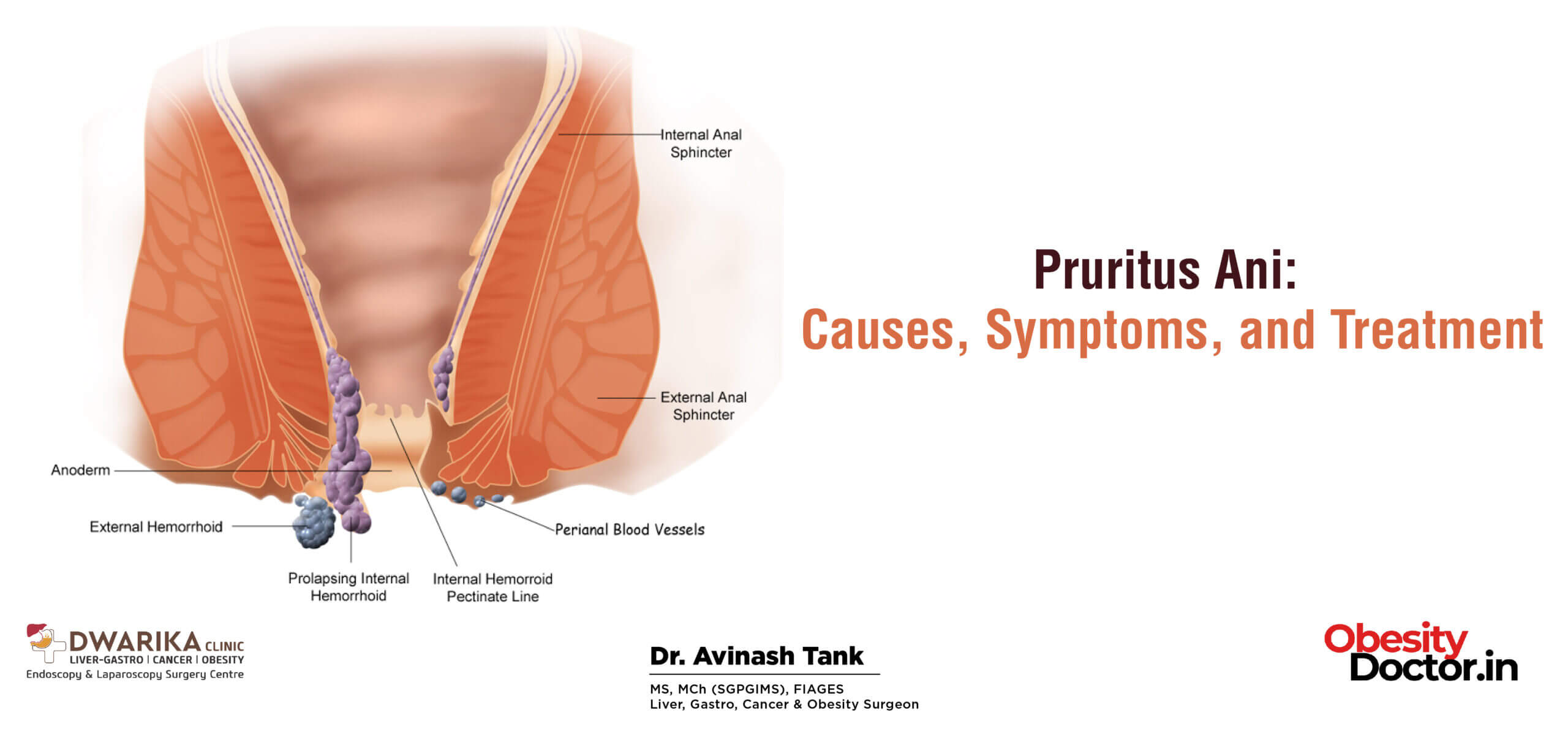 Pruritus Ani Causes, Symptoms, and Treatment   Dr AvinashTank, is ...