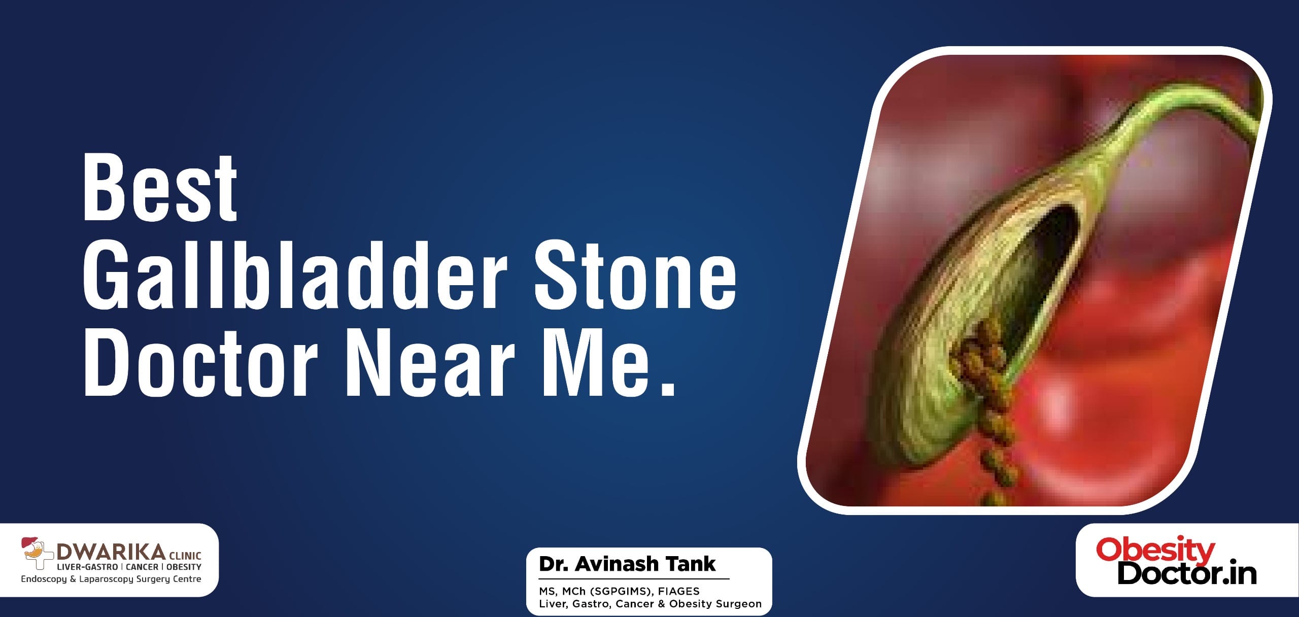 Gallbladder Archives Dr AvinashTank, is a superspecialist (MCh