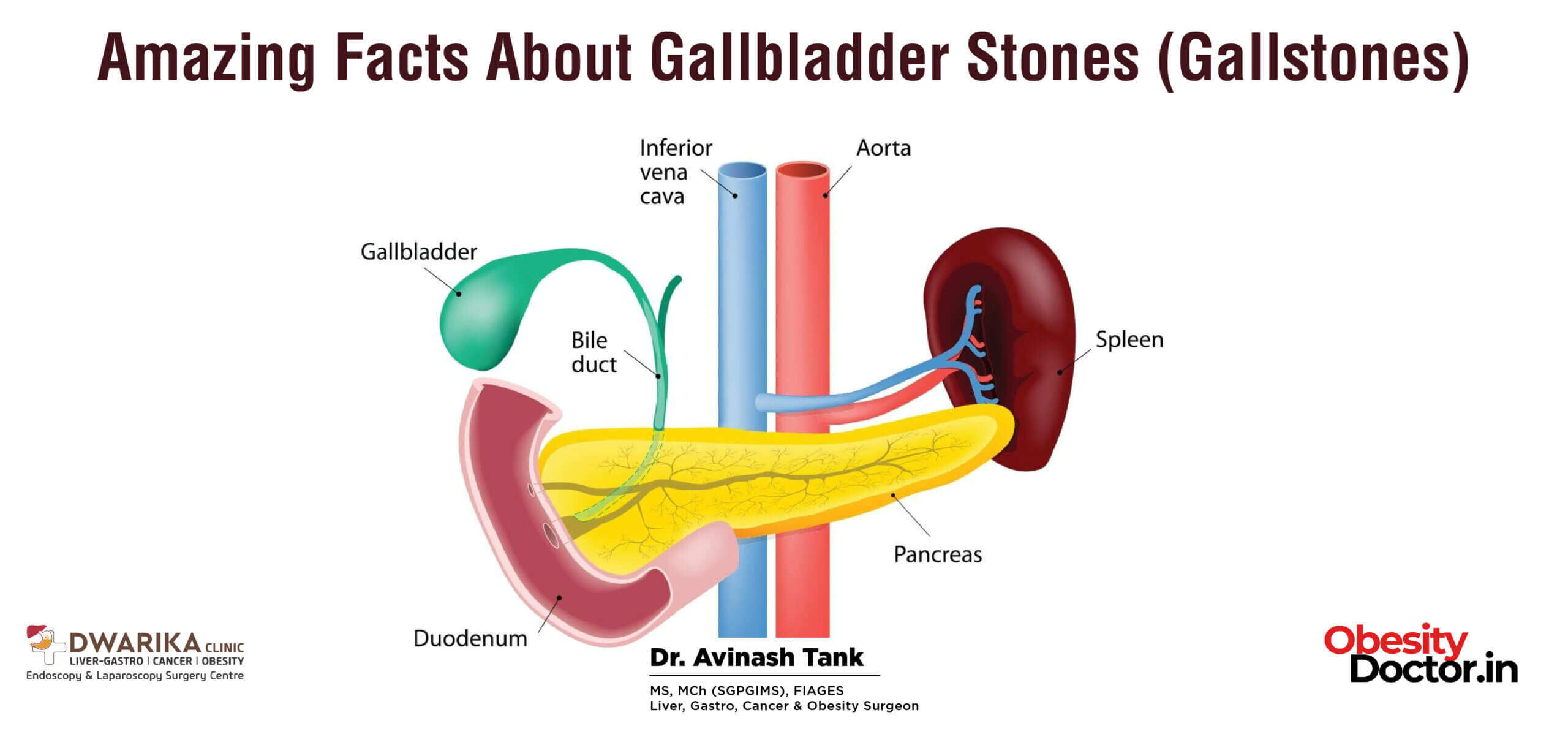 Amazing Facts About Gallbladder Stones (Gallstones)