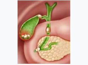 Complications of Gallbladder Stones