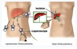 Benefits of Laparoscopic Gallbladder Surgery