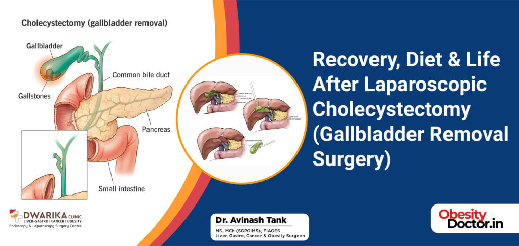 Recovery, Diet & Life After Laparoscopic Cholecystectomy (Gallbladder ...