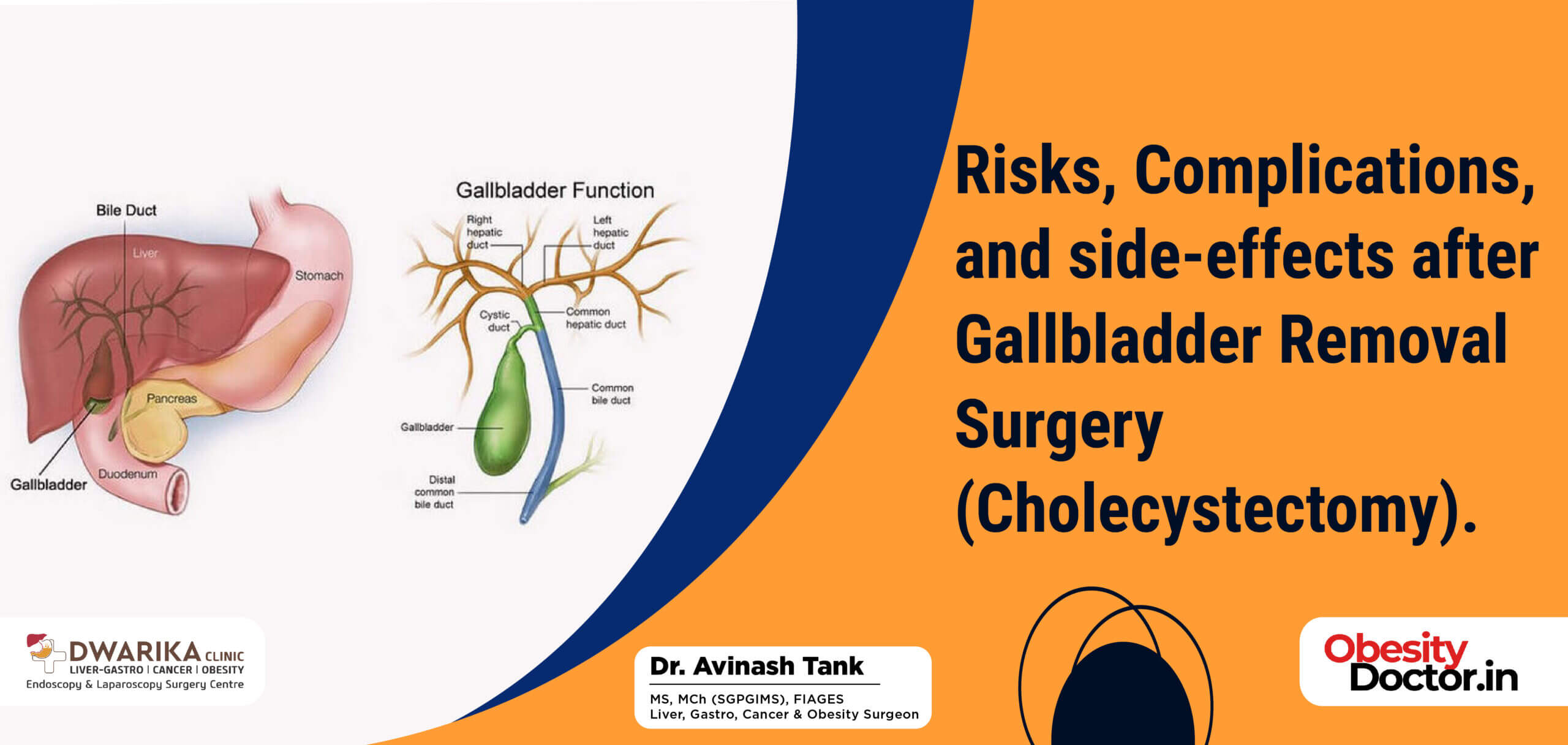 Risks, Complications, and side-effects after Gallbladder Removal ...