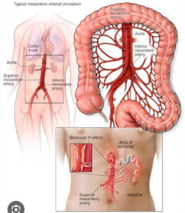 Intestine Attack (Ischaemia 