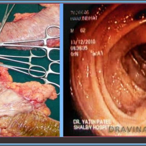 Colon Diverticular Bleeding